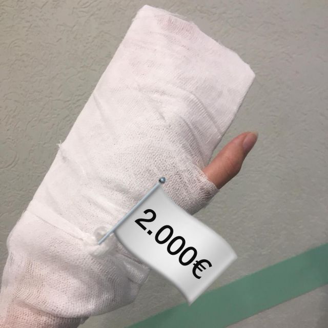 Bild der gebrochenen Hand meiner Mitbewohnerin